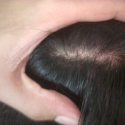 Common Causes Of Children Hair Loss