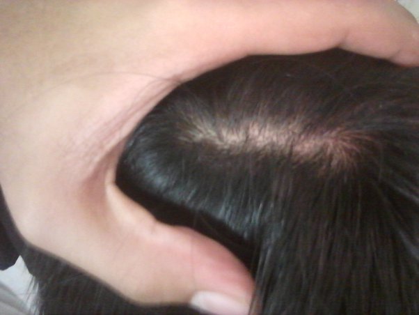 Common Causes Of Children Hair Loss